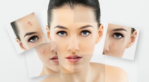 [ZAGREB] Akne i mrlje na koži koje su ostale nakon akni su veliki problem! Riješite se tog problema uz super ponude Laser centra Trinity i Crnog Jaja za samo 99 kn!