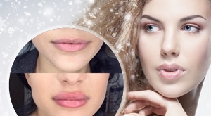 Ponuda za osvježene i prirodne usne u Beauty centru Callisto u Puli! Počastite se s 1 ml hyaluronskog filera apliciran hyaluronskim penom uz 50 % popusta – za samo 999 kn!