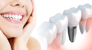 [VRHUNSKA STOMATOLOGIJA] Sretni razvucite široki osmijeh! UGRADITE IMPLATANT u stručnim rukama dentalnog centara „EsteticaDent“ u Oroslavju po nevjerovatnoj cijeni od samo 2799 kn!