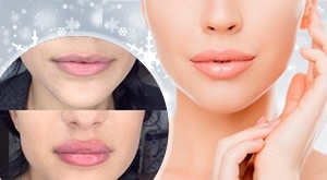 Ponuda za povećanje i osvježenje usana i lica te popunjavanja bora u Beauty centru Callisto u Puli – 1 ml + 0,5 ml gratis hyaluronskog filera apliciran hyaluronskim penom uz 66% popusta!