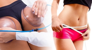 Sjajni paket za mršavljenje i oblikovanje tijela u Studiu T D u Osijeku – BUTT LIFT vakumom u 10 dolazaka uz 50% popusta!
