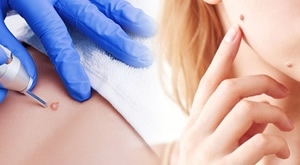 Neugodne bradavice i izrasline uklonite bezbolno uz uređaj PLASMA PEN u Bio+klink kozmetičkom salonu na 2 lokacije u Zagrebu! Uključeno uklanjanje 1 ili 10 izraslina, uz do 52% POPUSTA…