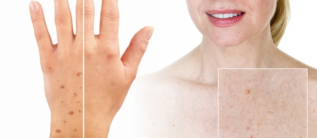 Uklonite fleke i mrlje na šakama ili dekolteu uz 3D IPL Alpha tretman u Beauty Centar Kozlinger