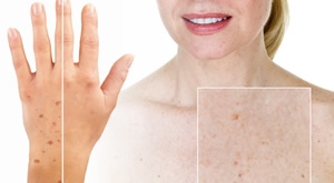 Uklonite fleke i mrlje na šakama ili dekolteu uz 3D IPL Alpha tretman u Beauty Centar Kozlinger