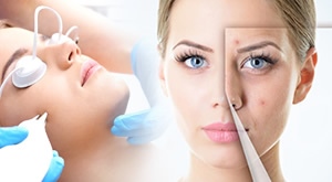 Lasersko uklanjanje akni ili fotopomlađivanje u Studiu Melanis u Zagrebu!