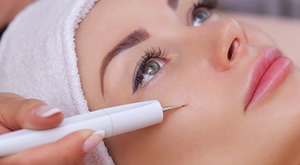 Uklanjanje neželjenih kapilara s lica u Beauty Centru Kozlinger u Zagrebu! 