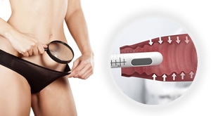 Vratite tonus VAGINALNIM MIŠIĆIMA uz 1 ili 3 tretmana VAGINALNI HIFU-om kod dr. med. Danijela Šeba!