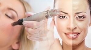 Iglična mezoterapija botopeptidima u Medelina Health Studiu u Zagrebu uz dr. Sanju Jeleković!