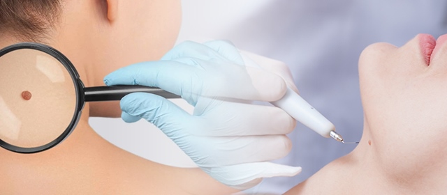 Poliklinika VitalArt donosi odličnu ponudu za uklanjanje madeža, bradavica ili lipoma bez šavova!