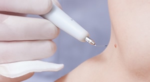 Poliklinika VitalArt donosi odličnu ponudu za uklanjanje madeža, bradavica ili lipoma bez šavova!