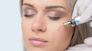 PLASMA PENOM uklonite madež veličine do 1 cm u ordinaciji dr. med. Danijela Šebe u Zagrebu!