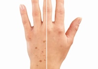 Uklonite fleke i mrlje na šakama ili dekolteu uz 3D IPL Alpha tretman u Beauty Centar Kozlinger