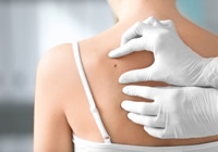 Uklanjanje madeža, bradavica ili lipoma uz dermatoskopski pregled u Poliklinici Superiora u Zagrebu!