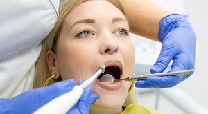 Za blistav osmijeh -  profesionalno čišćenje, pjeskarenje i izbjeljivanje u ordinaciji Dental Župan!