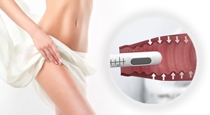 Uz stručne ruke dr.med. Danijela Šeba uklonite tegobe inkontinencije i menopauze - VAGINALNI HIFU!