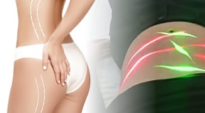 [SPECIJALNA PONUDA] MAXLIPO MASTER SLIM 10D laser – revolucija mršavljenja u Bio+Klinik salonu! 