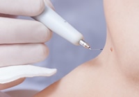 Poliklinika VitalArt donosi odličnu ponudu za uklanjanje madeža, bradavica ili lipoma bez šavova!