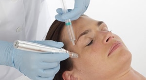 Microneedling u Val Beauté – pomlađivanje kože uz limfnu drenažu i manikuru kao poklon